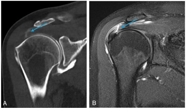 South Korean Study Confirms Low-Dose CT Arthrography Reduces Radiation Exposure in Shoulder Examinations