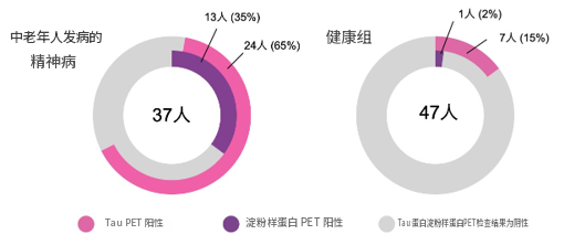 日本研究团队用PET显像发现tau蛋白病变或参与中老年幻觉妄想发生