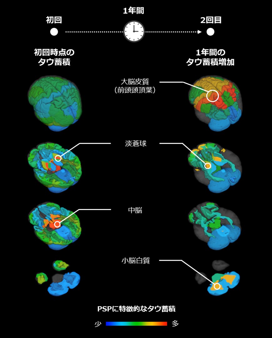 日本研究利用tau PET揭示进行性核上性麻痹症状进展关联